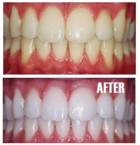 teeth_whitening_treatment