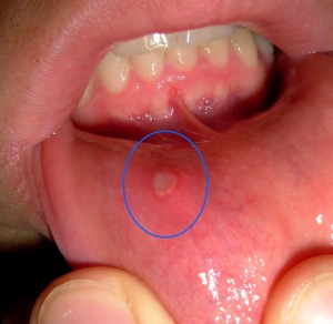oral ulcer