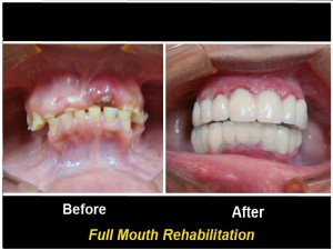 full-mouth-rehabilitation